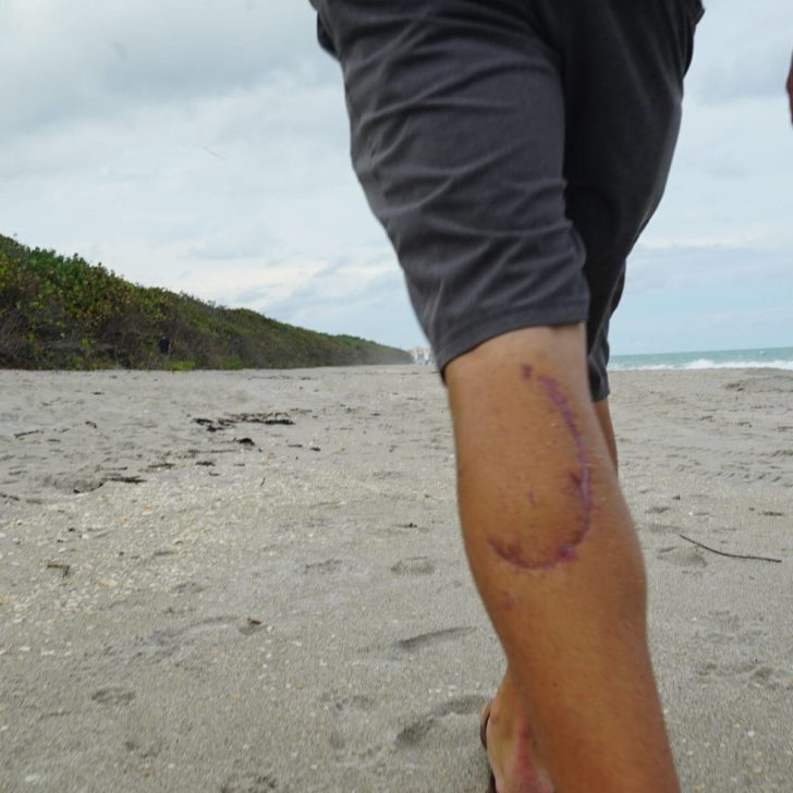 Closeup of a scar from a shark attack on a man's calf while he is walking on the beach.